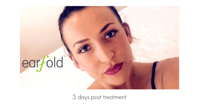 Changes Ear Fold - V5